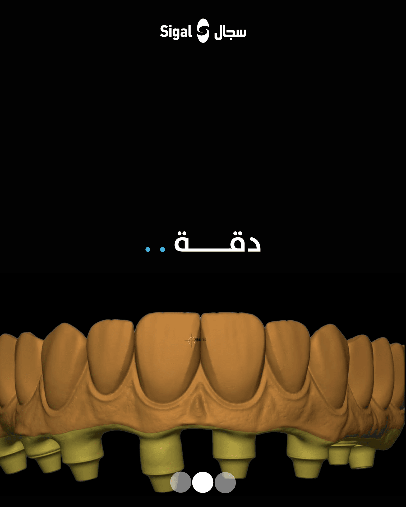 نموذج من أعمال معمل سجال الرقمي للأسنان رقم 4