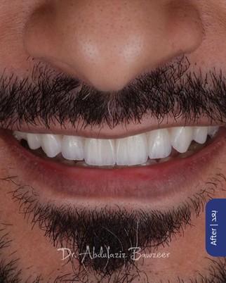الأسنان بعد علاج التجميل بالعدسات والتركيبات