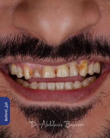 الأسنان قبل علاج التجميل